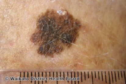 Melanoma-6