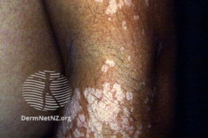 tinea versicolor melanotan What Is Versicolor? Symptoms, Causes, Diagnosis, Treatment, and Prevention Tinea Versicolor | Bikowski Skin