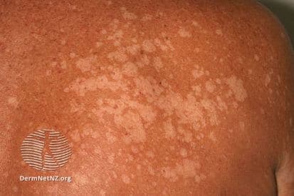 glutathione tinea versicolor Tinea versicolor - Wikipedia