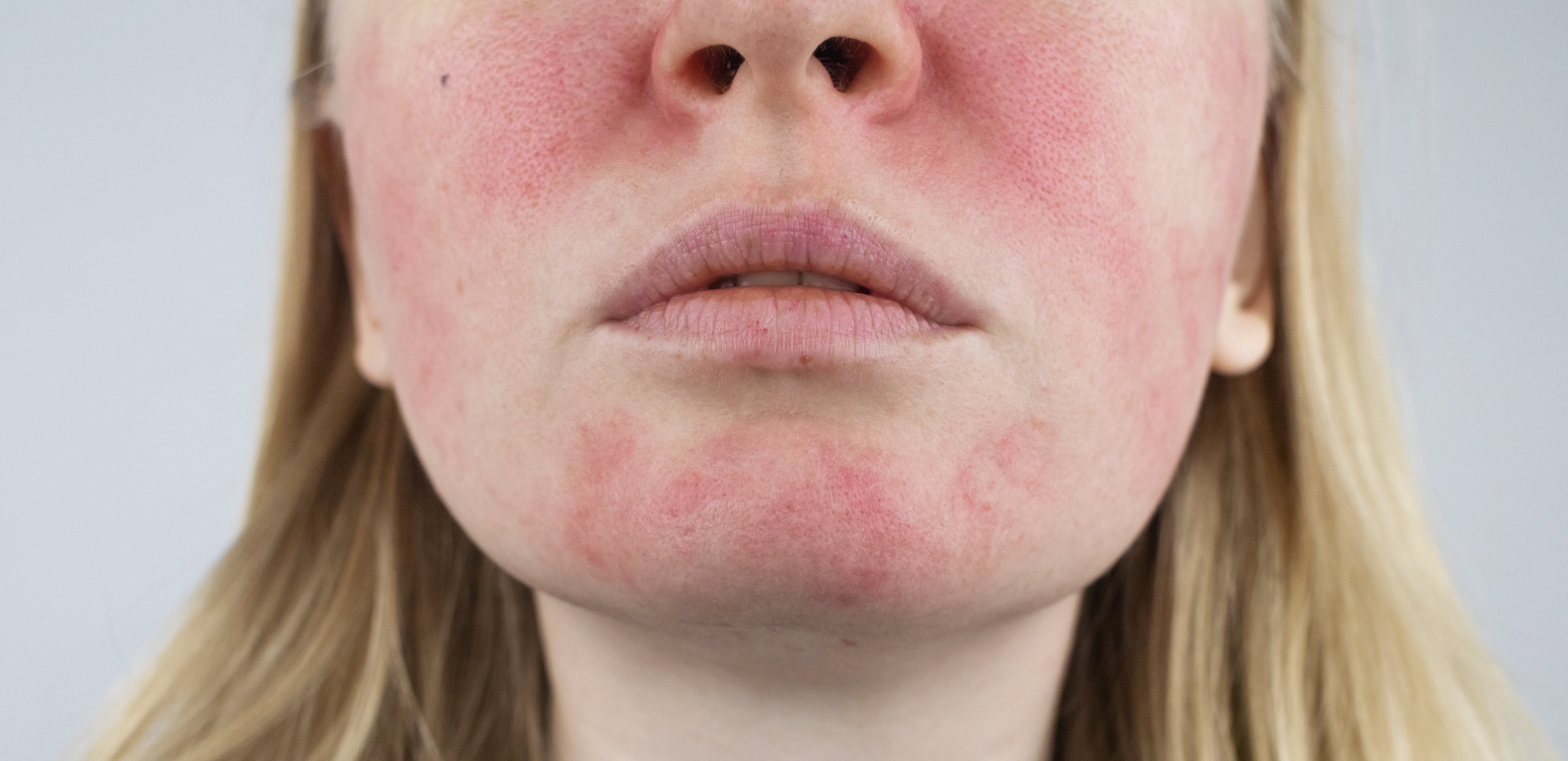 rosacea4