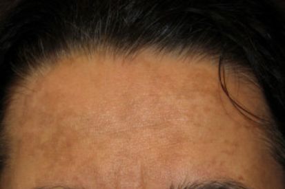 Melasma4